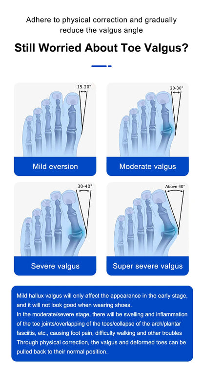 StrideAlign™ Bunion Corrector: Unisex Toe Straightener & Pain Relief High Shine