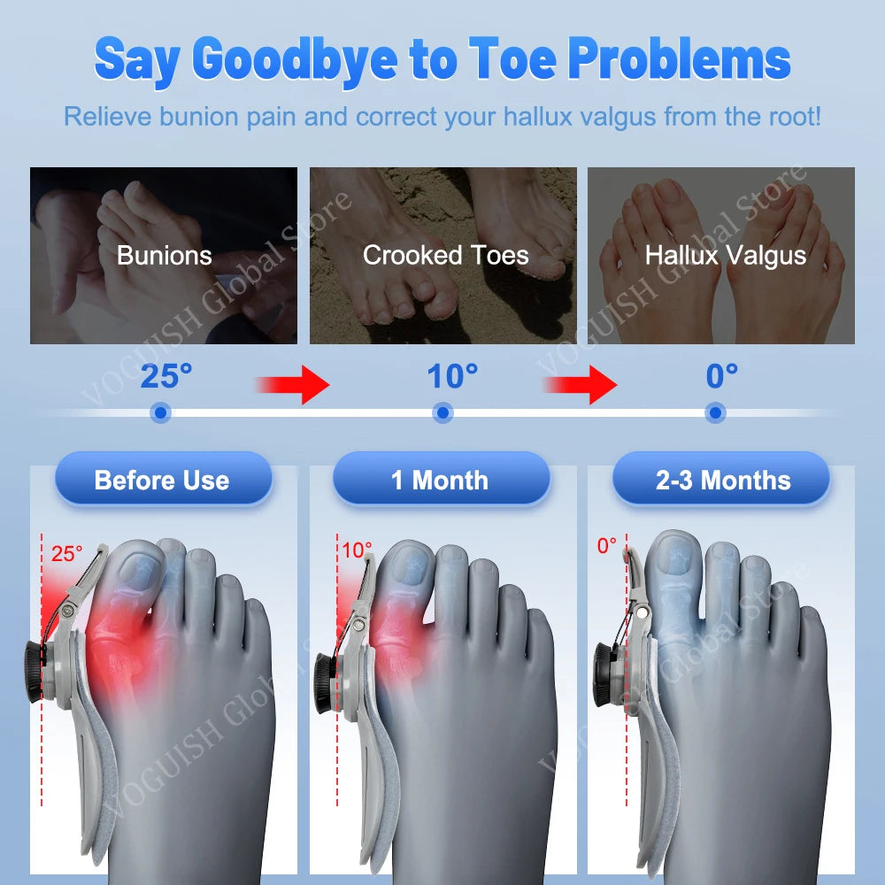 StrideAlign™ Bunion Corrector: Unisex Toe Straightener & Pain Relief High Shine